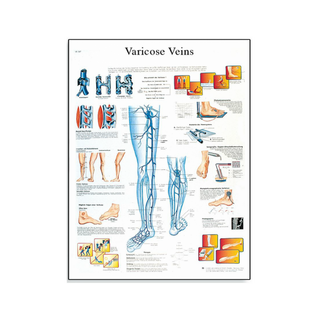 Póster laminado sobre venas varicosas