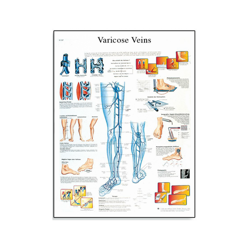 Póster laminado sobre venas varicosas