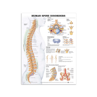 Póster de enfermedades de la columna vertebral en inglés