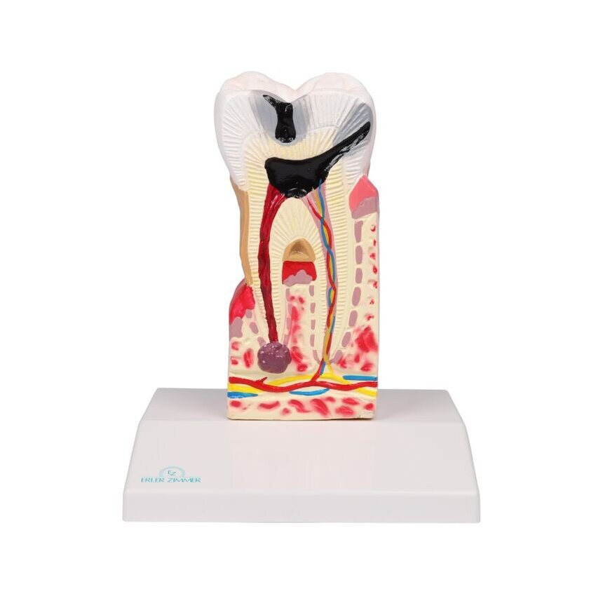 Modelo de caries dental, 10 veces su tamaño natural