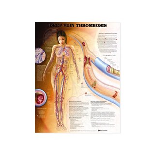 Trombosis venosa profunda (TVP) - póster