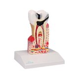 Modelo de caries dental, 10 veces su tamaño natural