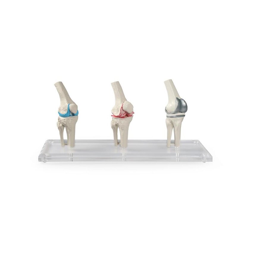 Modelo de implante de rodilla