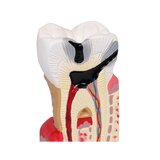 Modelo de caries dental, 10 veces su tamaño natural