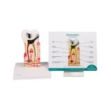 Modelo de caries dental, 10 veces su tamaño natural