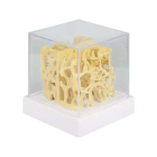Modelo de comparación de la estructura ósea sana/osteoporótica