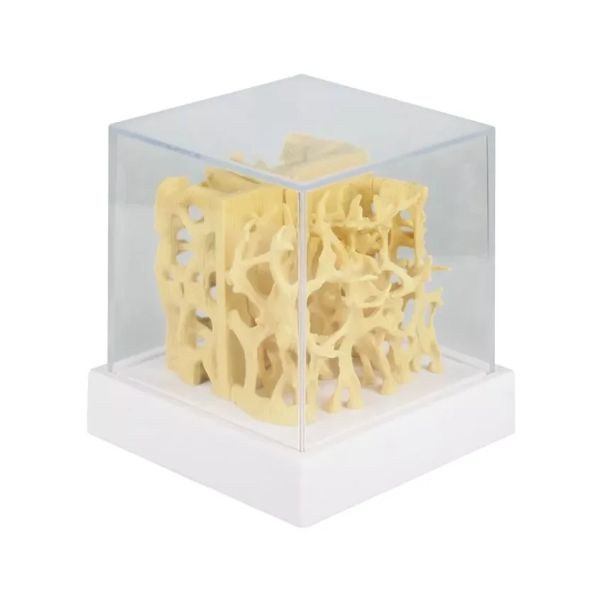 Modelo de comparación de la estructura ósea sana/osteoporótica