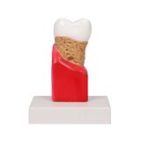 Modelo de caries dental, 10 veces su tamaño natural