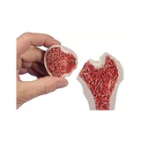Osteoporosis del fémur