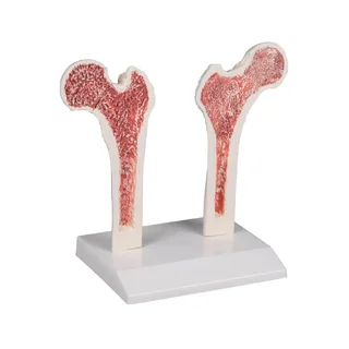 Osteoporosis del fémur