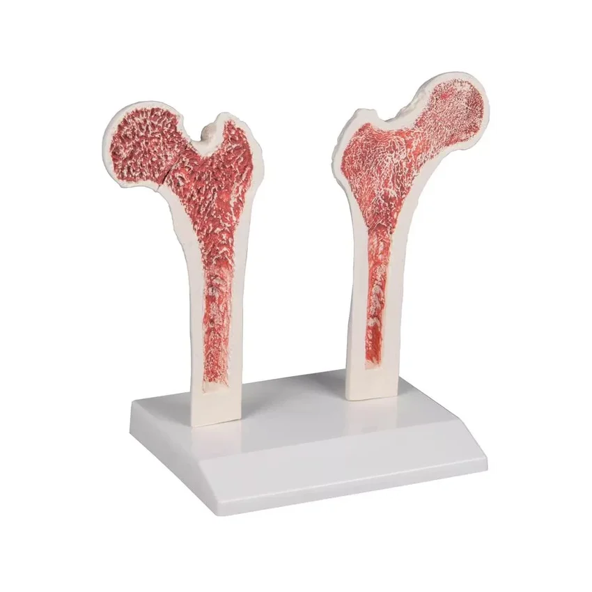Osteoporosis del fémur